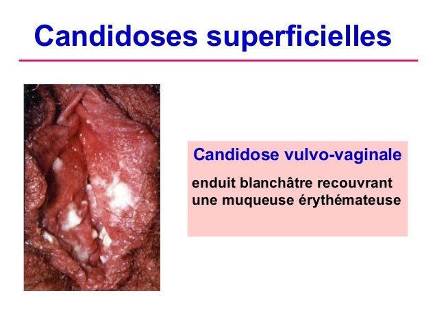 candidose génitale candidose génitale